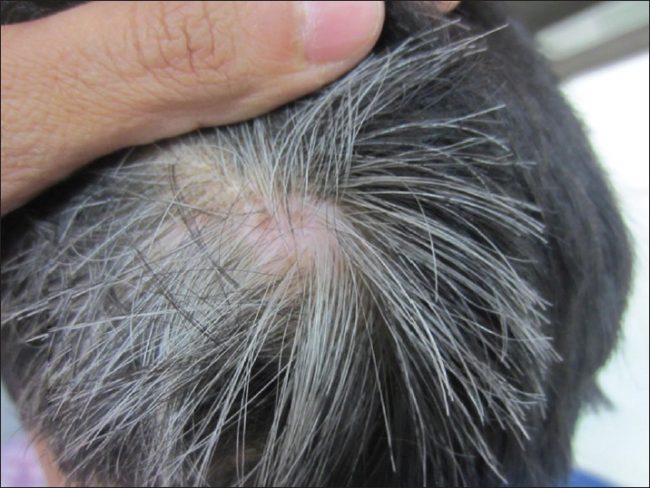 Premature greying of hair