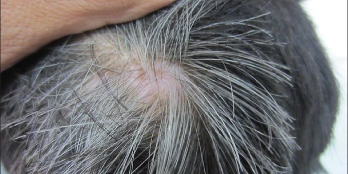 Premature greying of hair